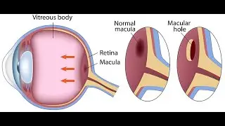 Moorfield Eye Hospital-- Macular Hole Surgery