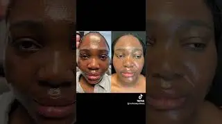 #Moxi On DARK SKIN! Choose Your Laser Center carefully #dmvlaser #bolusmedspa #maryland #beauty