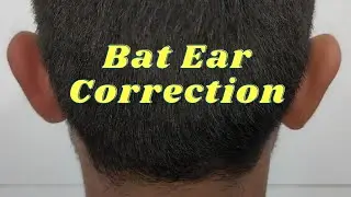 Bat Ear treatment| Correction of prominent ear| Surgery of bat Ear
