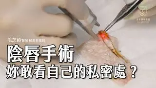 【私密處美學】仿小陰唇手術｜婦產科 #毛芝岭醫師｜#金貞醫學美容