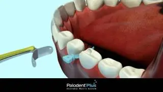 Palodent Plus Sectional Matrix System overview