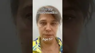 See her transformation | Face Fitness | Face Yoga | Posture Correction