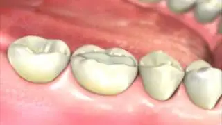 White Fillings Overview - Tooth Colored Fillings