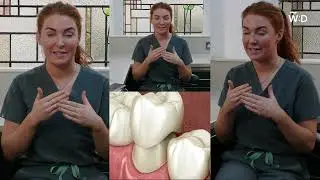 Porcelain veneers vs Composite bonding