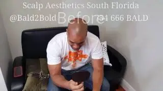 Scalp Aesthetics Micropigmentation South Florida