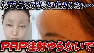 【PRP注射の数年後の危険性について】おでこを丸くしたら最悪な結果になりました…