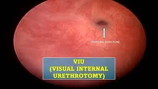 VIU (VISUAL INTERNAL URETHROTOMY) DONE FOR SHORT SEGMENT URETHRAL STRICTURE