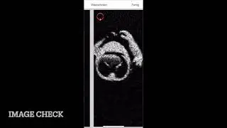 Step 5: second trimester scan without guidance