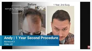 Second Coat of Paint! Natural Transplants 1 Year Check In | Dr. Huebner (Andy)