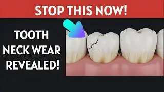 3 PROVEN Ways to Stop Tooth Neck Wear — Dentist Explains