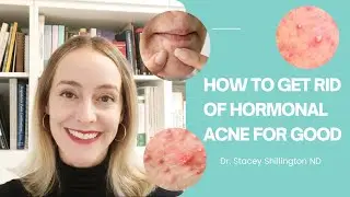 How to Get Rid of Hormonal Acne For Good