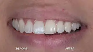 416 Dentistry | DMG Icon to remove white spots on teeth