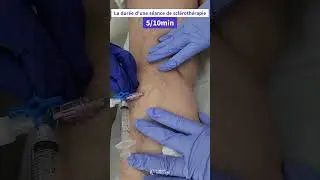 Traitement par  scl&eacute;roth&eacute;rapie💉