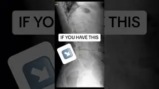 #chiropractic adjustments based off your #xrays
