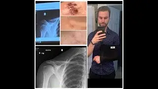 DISTAL CLAVICLE EXCISION | 6 MONTH UPDATE | FULL TIMELINE