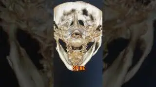 Vertigo and Dizziness Natural Solution with Advanced Spinal Imaging