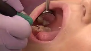 MirrorSuction DS
