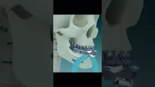 &Ccedil;ene İleriliği - Geriliği | Ortodonti Uzmanı &Ccedil;ınar Gaffari