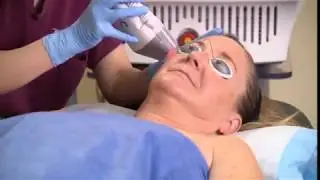 Acne Scar Removal with Fraxel Laser