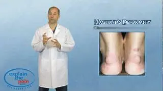 What is Haglund's Deformity or 