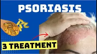 PSORIASIS Treatment &ndash; The BEST 3 REMEDIES for Psoriasis