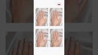 Hand rejuvenation (Ageing Hands) by Prof. Dr. Robert Hierner, plastic surgeon UAE