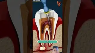Special treatment of infected tooth with the help of 3d animation