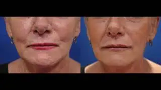 Dr.  Dean Kane Injects Filler to the Lips