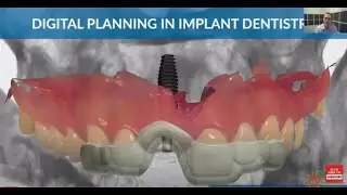 Digital Planning in Implant Dentistry by Dr Brian Goodacre