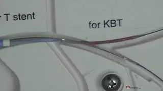 DK crush bifurcation stenting.