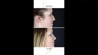 Rhinoplasty Results with Dr. Sobel - Addressing a Dorsal Hump