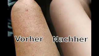 Endlich sch&ouml;ne Haut 😀 was hilft bei mir gegen meine Reibeisenhaut / Pickel an den Armen und Beinen