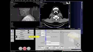 CT Scan of Neck with Contrast full process