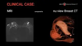 Breast CT in comparison to MRI: The power of nu:view