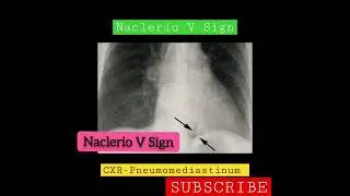 CXR sign - Naclerio V Sign - Pneumomediastinum