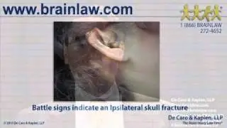 Skull Fractures: Important Information for a Brain Injury Attorney