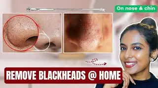 How To Remove Blackheads At-Home | Blackheads Extraction Process