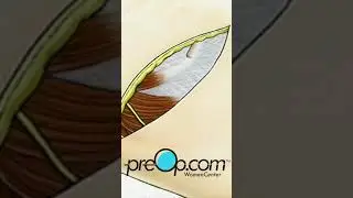 PreOp&reg; 📚 Radical Mastectomy Explained #preop #shorts 🧬