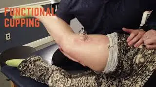Functional & Static Cupping