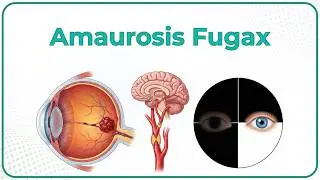 Amaurosis Fugax 👁️ Internal Medicine Neurology/Ophthalmology | USMLE Step 2 CK