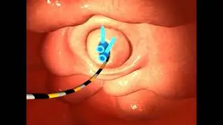 Fusion Oasis One Action Stent Introduction System Animation