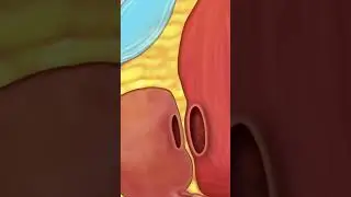 Open Surgery Radical Prostatectomy - PreOp&reg; Patient Eduction #shorts #medicine #patienteducation