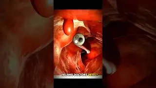Exploring the INSIDE of Your Body with Endoscopy!|3D Animation #health #anatomy  #canceranimation