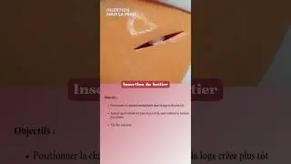 POSE DE PAC ➡️ Insertion de la chambre sous la peau
