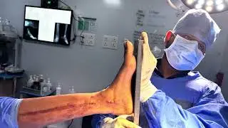 Post-compartment syndrome foot deformity / equinocavovarus deformity/ rigid foot drop deformity