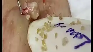 satisfying Blackheads Removal | dep spa spa new | giant blackheads removal on face
