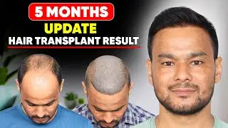 Best Hair Transplant in Surat (HX-HHDH) | Best Results & Cost of Hair Transplant in Surat.
