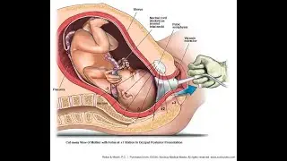 Can forcep or vaccuum extraction devices causes injury?