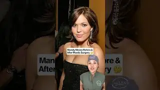 Mandy Moore before and after plastic surgery. #plasticsurgeon #blepharoplastysurgery #eyelidsurgery