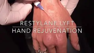 Restylane Lyft Hand Rejuvenation done with cannulas by expert injector, Dr. Steven F Weiner